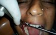 4. Tooth Removal