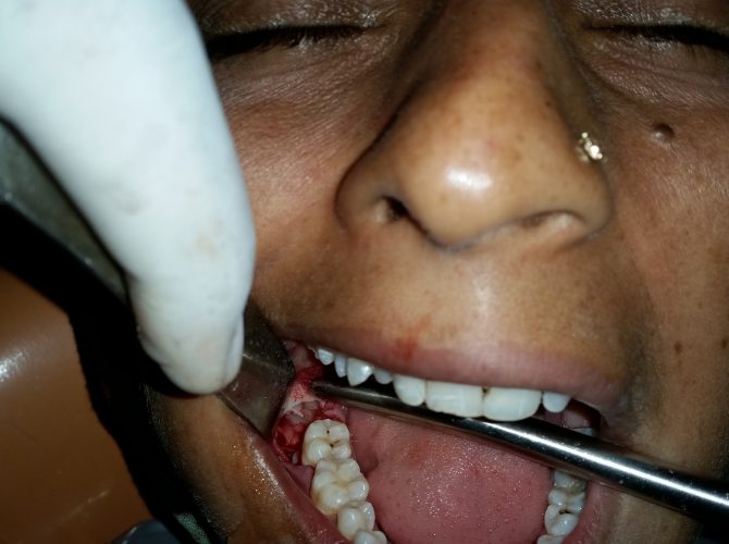 4. Tooth Removal