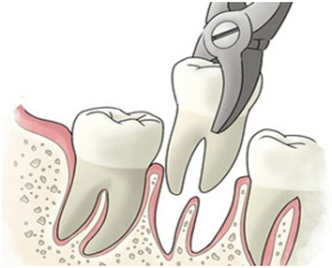 Extractions-Tooth-Removal1