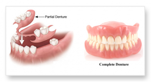 Full-mouth-Denture