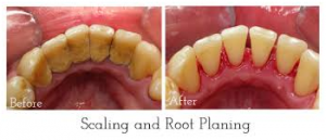 Teeth-Cleaning2